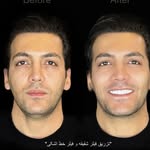 فیلر شقیـقه