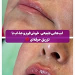 فیلر لب